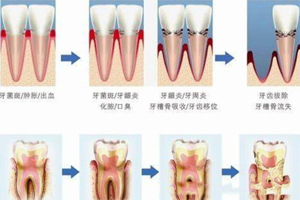 预防牙周炎个人自我保健常用方法是什么药(预防牙周炎个人自我保健常用方法