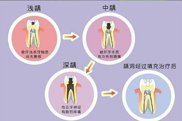 牙齿有虫牙怎么办中间变黑用什么牙膏好(虫牙黑黑的用什么洗