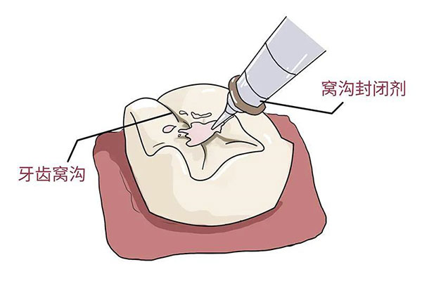 洁牙后涂氟后多久可以刷牙呢(洁牙后涂氟后多久可以刷牙呢视频)