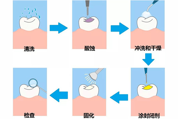 儿童涂氟怎么操作方法(儿童涂氟怎么操作方法图解)