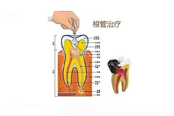 牙齿龋坏根管治疗(牙齿龋坏根管治疗全过程)