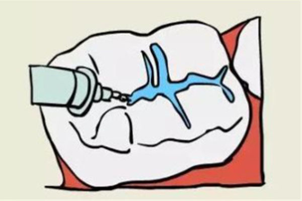 牙齿涂氟涂几次最好(牙齿涂氟涂几次最好图片)