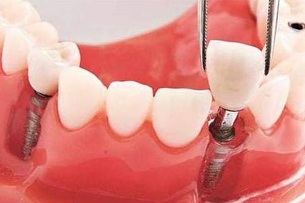 种植牙齿可以刷医保卡吗(种植牙齿可以刷医保卡吗)