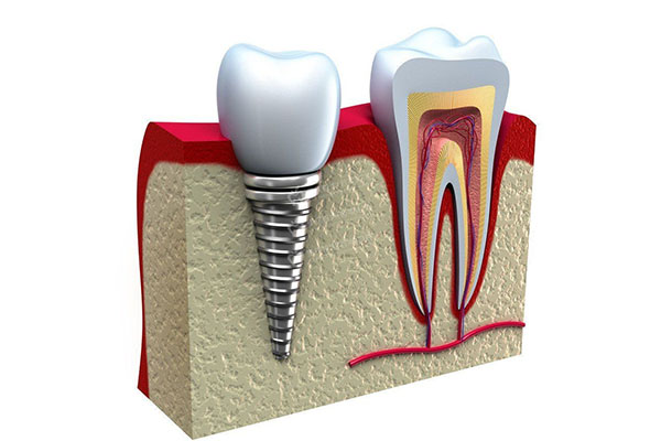 既刻负重种牙(即刻负重种植牙)