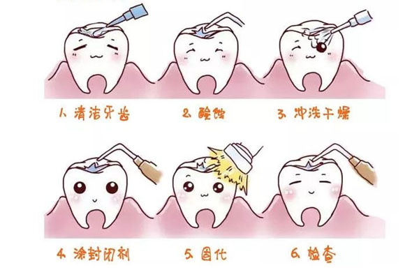 小孩涂氟一次要多少钱呢(小孩涂氟一次要多少钱呢视频)