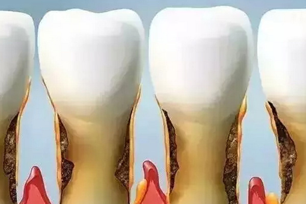 牙龈萎缩用什么中药治疗效果好一点(牙龈萎缩用什么中药治疗效果好一点图片