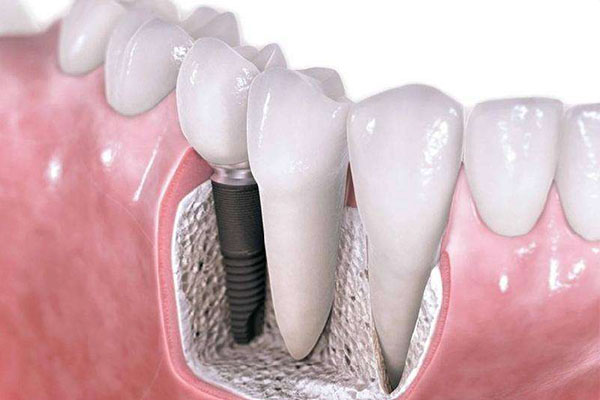 拔牙后多久可以种牙齿了(拔牙后多久才可以种牙)