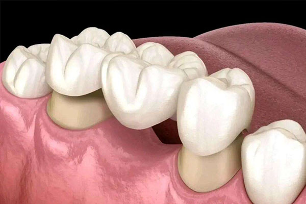 进口烤瓷牙哪个牌子的好一点(进口烤瓷牙哪个牌子的好一点耐用)