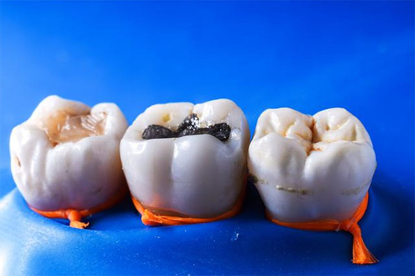 东莞市人民医院补牙收费标准表(东莞市人民医院补牙收费标准表图片)