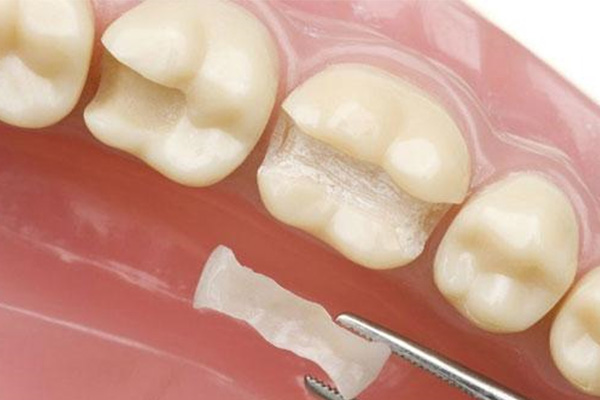 牙体缺损修复的治疗原则不包括哪些(牙体缺损修复的治疗原则不包括哪些)