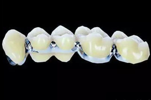 上海做烤瓷牙目前多少钱一颗(上海做烤瓷牙目前多少钱一颗牙)