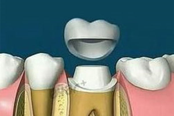 牙齿掉了两个怎么补(牙齿掉了两个怎么补最好)