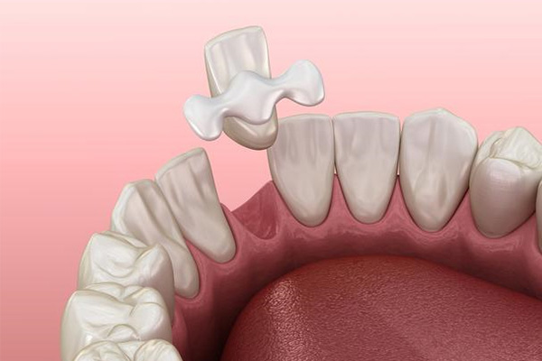 种植烤瓷牙多少钱一个月(种植烤瓷牙要多少钱)