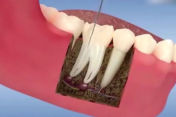 慢性根尖牙周炎一定要根管治疗吗多少钱一颗(慢性根尖牙周炎一定要根管治疗