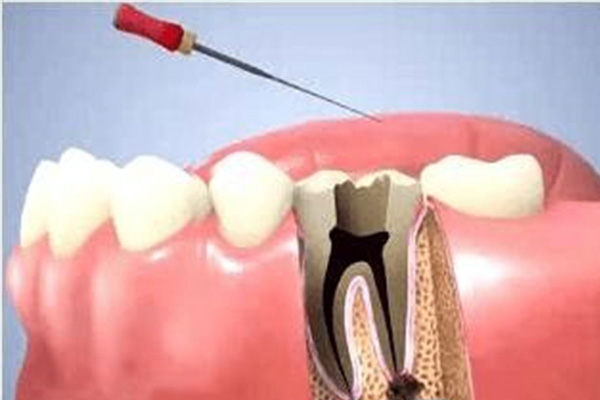 慢性根尖周炎根管治疗后还有胀痛怎么办(慢性根尖周炎根管治疗后还有胀痛怎