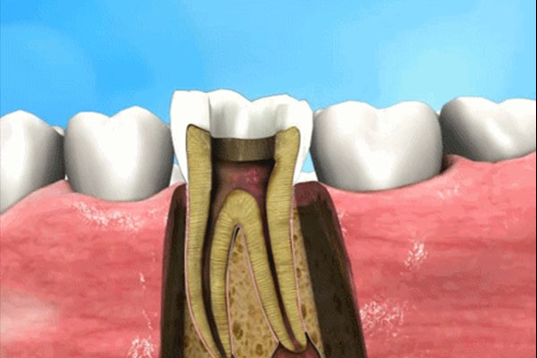 根尖炎鼓包很硬(根尖炎鼓包很硬怎么办)