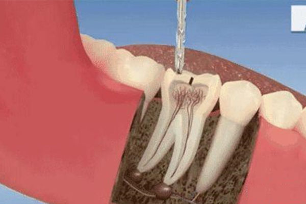 做根管治疗要去多少次医院才能做(做根管治疗要去多少次医院才能做好)