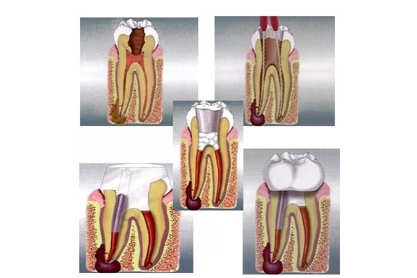 一整套根管治疗一共花多少钱