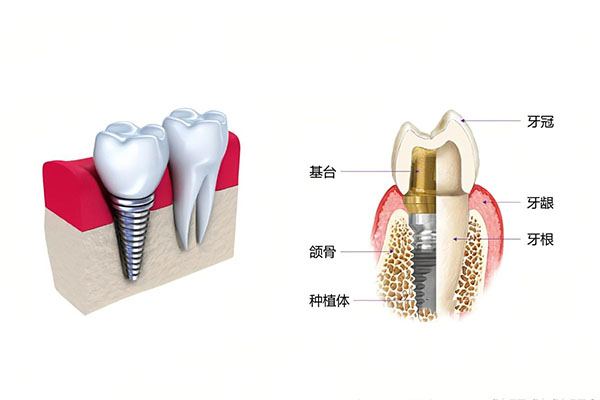 种牙全瓷冠和烤瓷冠(种牙全瓷冠和烤瓷冠的区别是什么)