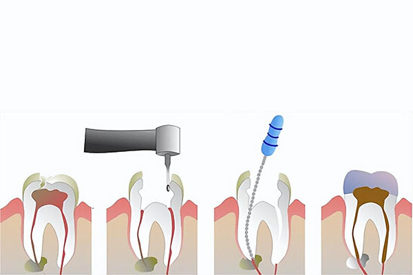 得了根尖周炎选择拔牙好还是根管治疗好(根尖周炎是拔牙还是做治疗)
