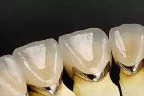 维他灵活动假牙