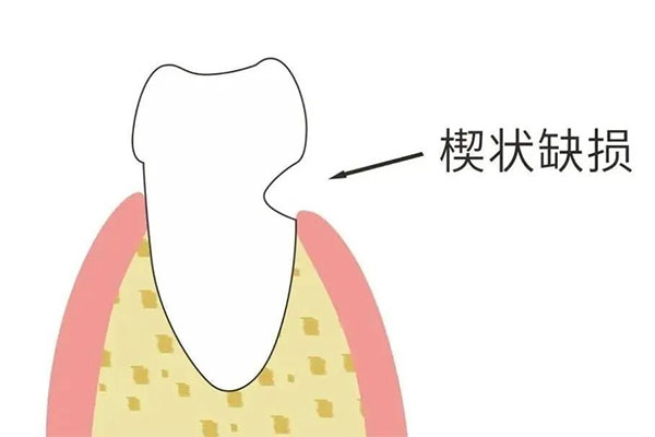 牙体缺损修复的类型主要包括(牙体缺损修复的类型主要包括什么)