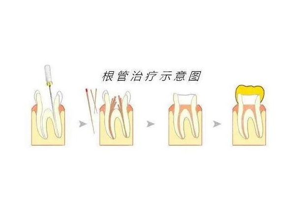 4岁孩子做根管治疗会有什么后遗症(4岁孩子做根管治疗会有什么后遗症嘛)