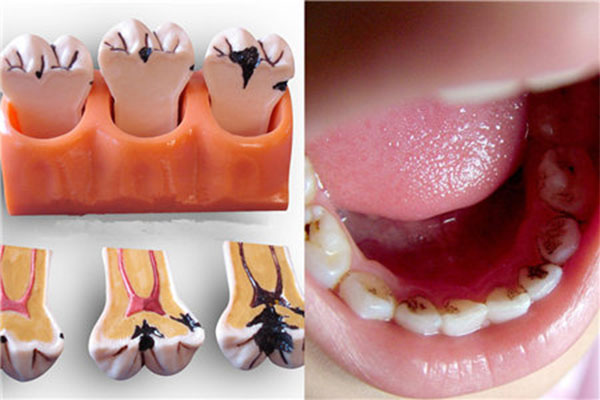 智齿蛀牙拔牙要多少钱(智齿蛀牙拔牙要多少钱)