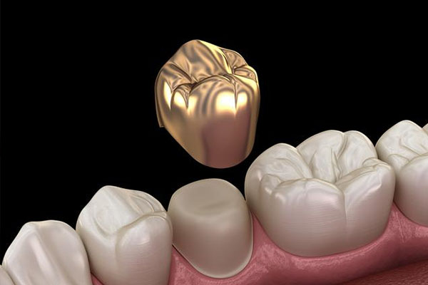 牙齿缺失一半怎么补好(牙齿缺失一半怎么补好一点)