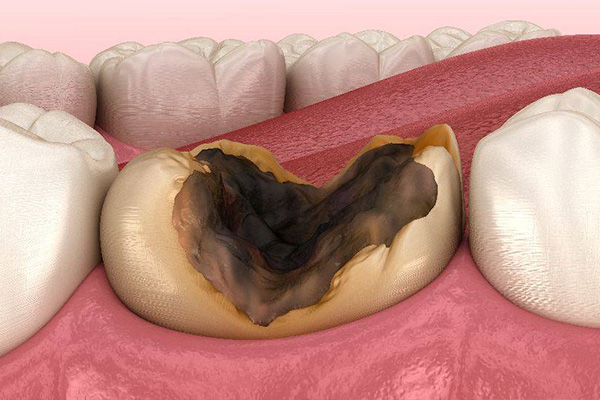 牙齿根部缺损怎么治疗(牙齿根部缺损怎么治疗好)