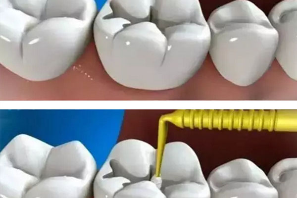 小孩窝沟封闭可以进医保吗多少钱(小孩窝沟封闭可以进医保吗多少钱一个月)