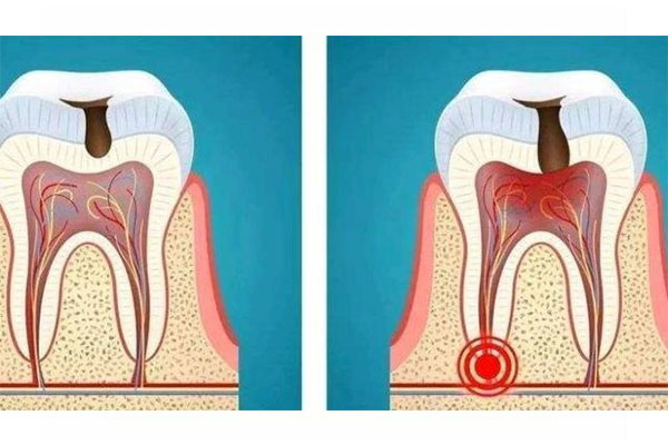 儿童蛀牙牙疼快速止疼方法有哪些(儿童蛀牙牙疼快速止疼方法有哪些呢)