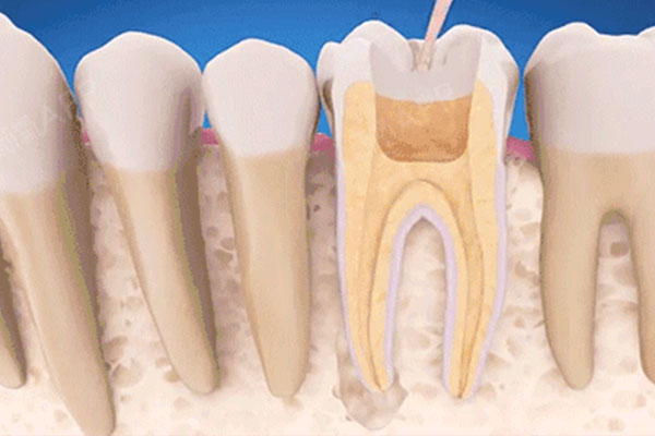 根管治疗做多少次比较好(根管治疗做多少次比较好一点)