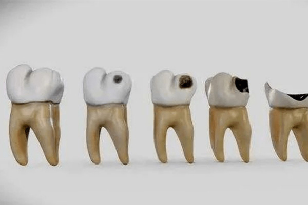 蛀牙根管治疗费用多少(蛀牙根管治疗费用多少钱一颗)