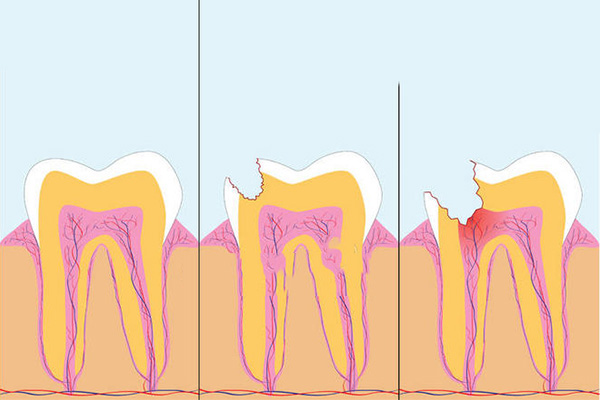 牙齿缺损治疗方案(牙齿缺损治疗方案)