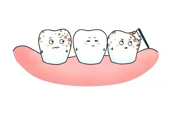 洁牙以后需要注意什么(洁牙以后需要注意什么问题)