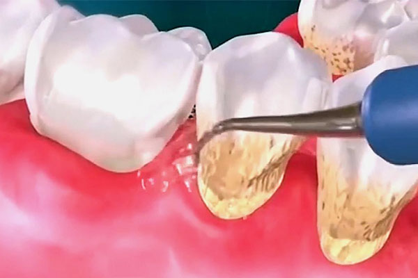 小孩子的牙齿黄是什么原因呢(小孩子的牙齿黄是什么原因呢图片)