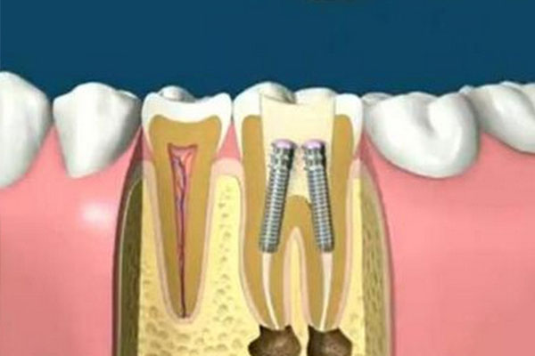深圳市种牙多少钱(深圳种牙要多少钱)