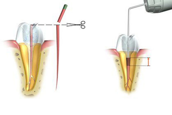 儿童做根管治疗多少钱一次(儿童做根管治疗要多少钱)