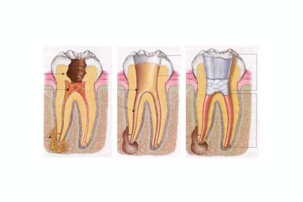 前牙根管治疗费用多少钱一颗