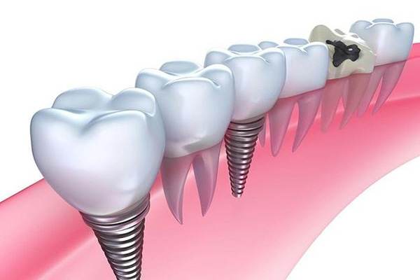 正畸需要多久 种牙(正畸需要多久 种牙好)