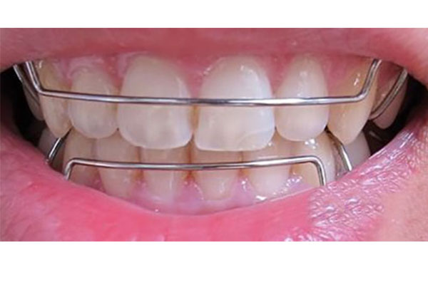 正颌手术医保卡报销吗(正颌手术医保卡报销吗能报销吗)