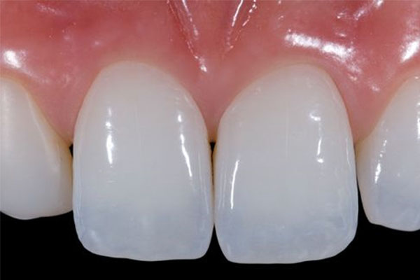 牙齿贴面后牙齿一碰就酸疼(牙齿贴面后牙齿一碰就酸疼还有冷)