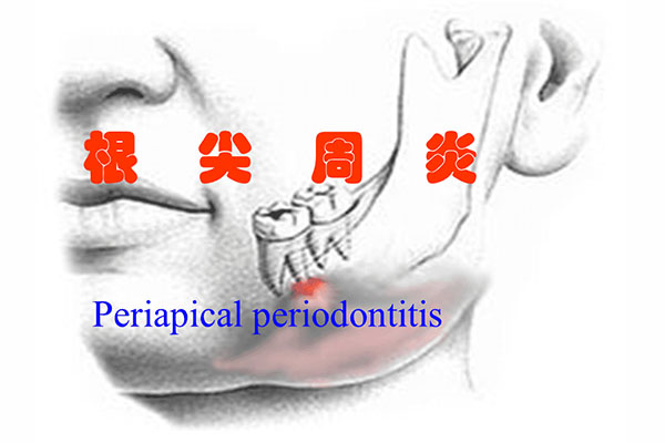 牙根尖周炎洗牙有用吗(牙根尖周炎洗牙有用吗图片)