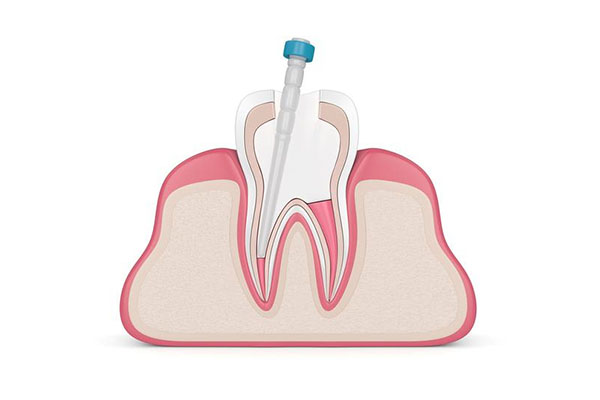乳牙根管多少钱一颗(乳牙根管多少钱一颗牙)