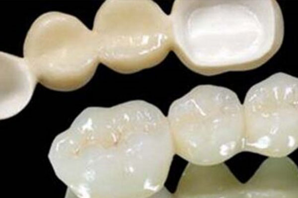 烤瓷牙贴面会变黄吗(烤瓷牙贴面会变黄吗怎么办)