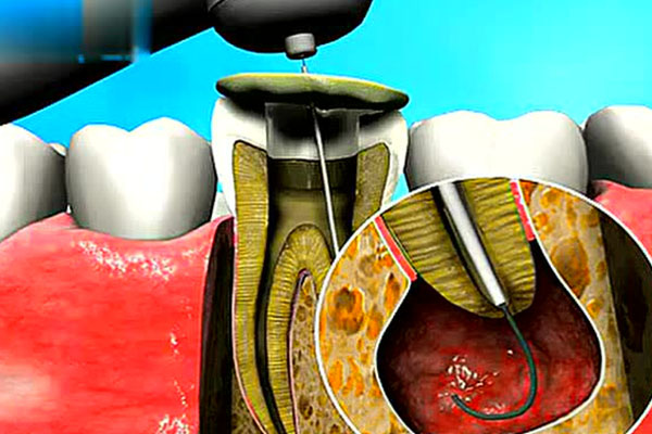 什么是牙齿的根管治疗