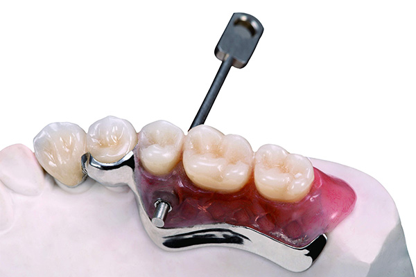 无铍烤瓷牙的优缺点及价格(无铍烤瓷牙怎么样)