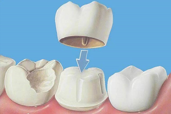 补牙后牙龈肿痛吃什么消炎药好(补牙后牙龈肿痛吃什么消炎药好呢)