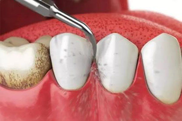 牙发黄怎么刷下来(牙发黄怎么刷下来白色)